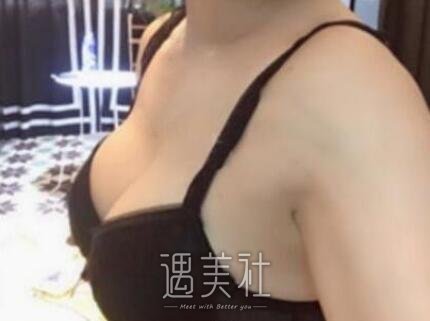 曹卫刚,自体脂肪隆胸