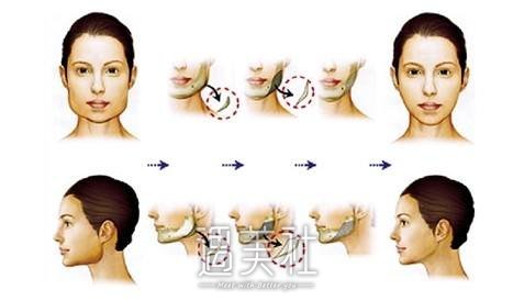 上海改脸型手术多少钱，一线城市都比较贵?