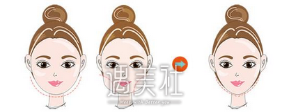 上海改脸型手术多少钱，一线城市都比较贵?
