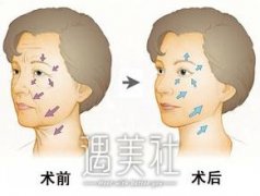 沧州等离子除皱价格贵不贵，影响收费的因素有什么? width=