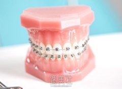 西安牙齿矫正贵不贵，什么影响了价格? width=