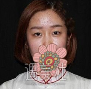 侯典举双眼皮案例：比预想中恢复得更好~ width=