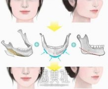 厦门做改脸型价格是多少，为什么价格这么高? width=