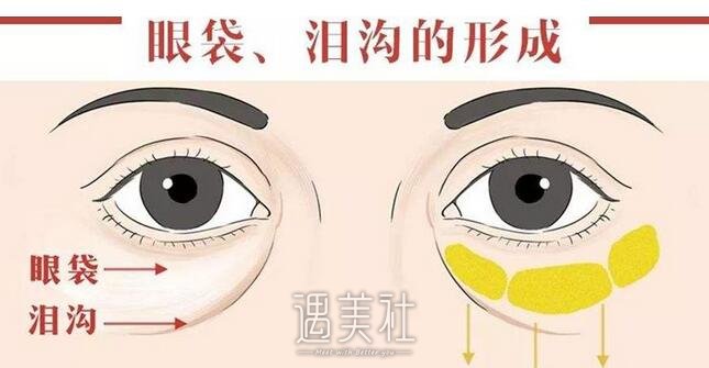 超声法去眼袋