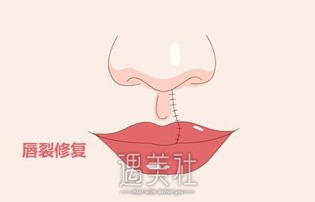 南京,兔唇手术