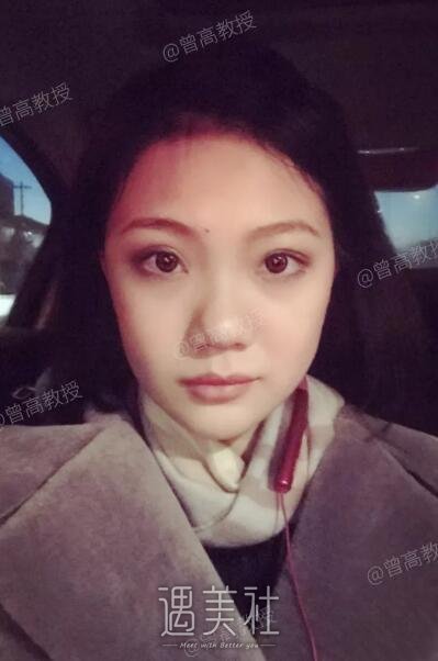 曾高隆鼻案例展示：看看她的神奇变化!