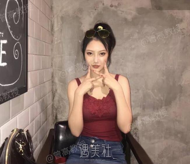 曾高隆鼻案例展示：看看她的神奇变化!