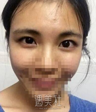 高柳进双眼皮案例曝光，前后根本不是一个人~