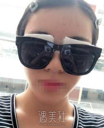 高柳进双眼皮案例曝光，前后根本不是一个人~