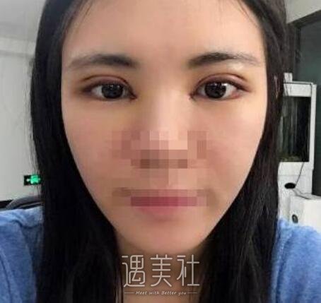 高柳进双眼皮案例曝光，前后根本不是一个人~