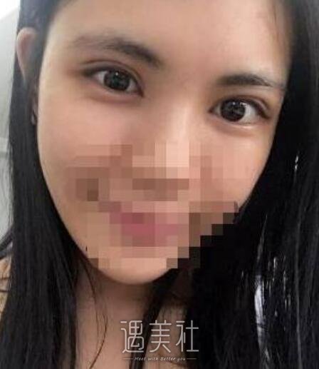 高柳进双眼皮案例曝光，前后根本不是一个人~
