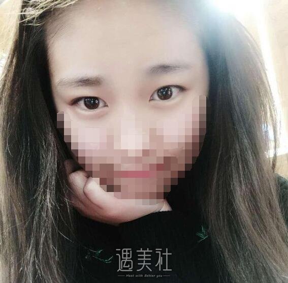 莫志波双眼皮手术案例分享，从此告别单眼皮认识~
