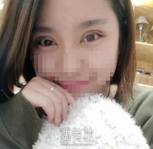 莫志波双眼皮手术案例分享，从此告别单眼皮认识~
