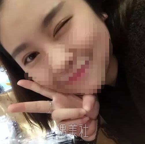 莫志波双眼皮手术案例分享，从此告别单眼皮认识~