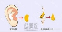苏州软骨隆鼻手术需要多少钱? width=