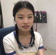 韩国扑成训双眼皮案例：果真的特别自然了~ width=