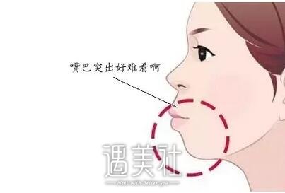 嘴唇整形