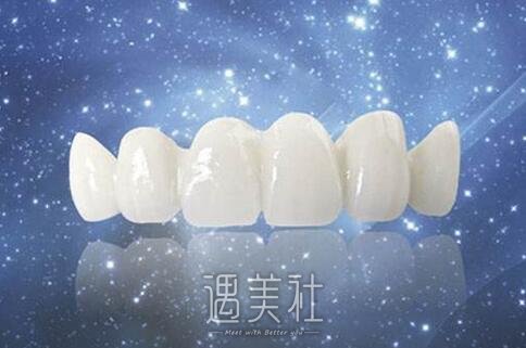 美容冠矫正龅牙