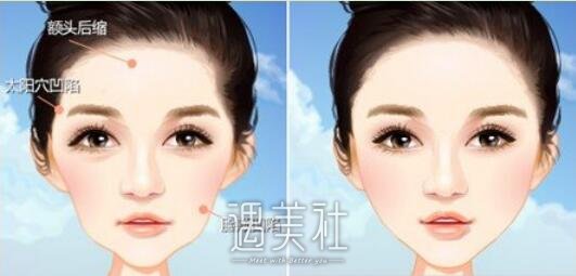杭州,自体脂肪填充