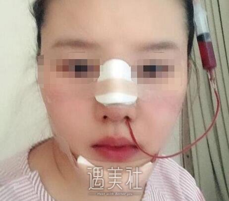 李战强,隆鼻