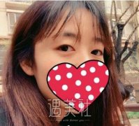 陈辉双眼皮案例~ width=