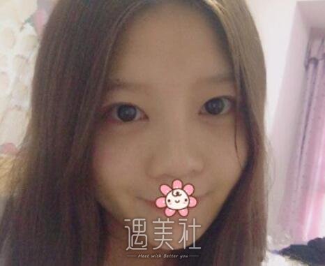 范飞，隆鼻