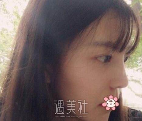 范飞，隆鼻