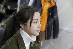 王艇隆鼻案例：颜值一下高出几个度! width=