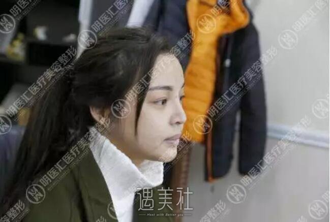 王艇隆鼻案例：颜值一下高出几个度!