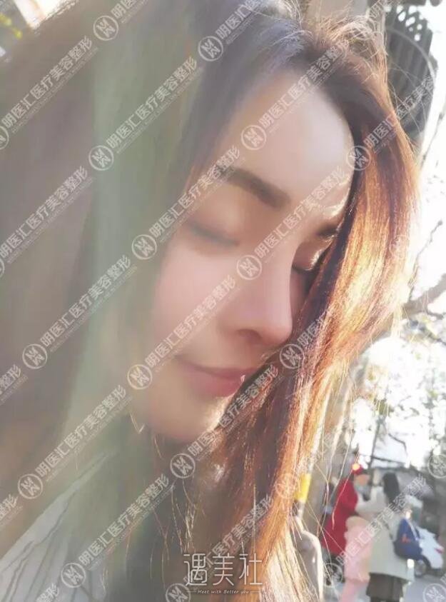 王艇隆鼻案例：颜值一下高出几个度!