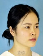 牛永敢隆鼻案例：感谢当初那个勇敢的自己~ width=