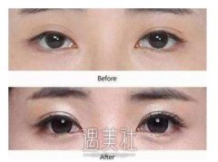 北京双眼皮失败修复价格，听说价格很贵? width=