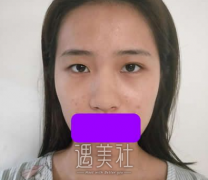 王旭明隆鼻案例：朋友渐渐多了起来~ width=