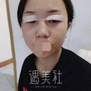 孙宝珊双眼皮修复案例：选择医院医生真的很重要! width=