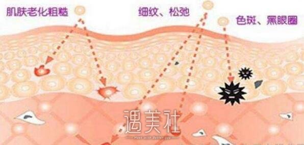 光子嫩肤祛斑