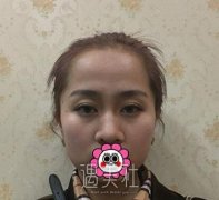 谢洋春隆鼻怎么样|谢洋春隆鼻案例硬核来袭~ width=