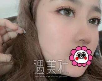 谢洋春,隆鼻