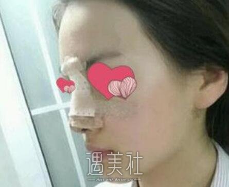 熊猛,隆鼻