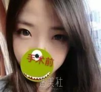 弋矶山医院整形科实力如何?双眼皮真实案例分享~ width=
