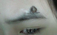 徐州祛痣多少钱，一颗价格也不贵吧? width=