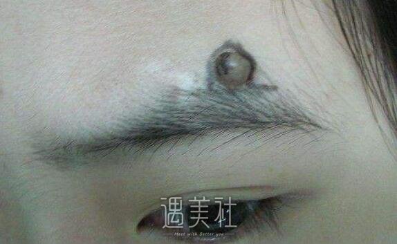 徐州祛痣多少钱，一颗价格也不贵吧?