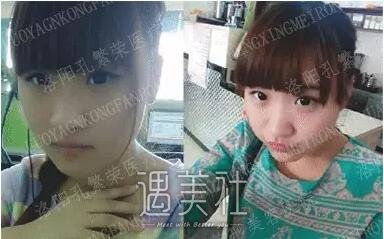 洛阳孔繁荣做双眼皮怎么样?真能出神入化的果?