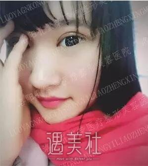 洛阳孔繁荣做双眼皮怎么样?真能出神入化的果?
