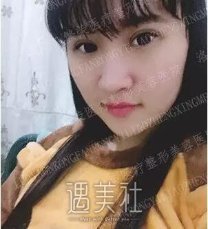 洛阳孔繁荣做双眼皮怎么样?真能出神入化的果?