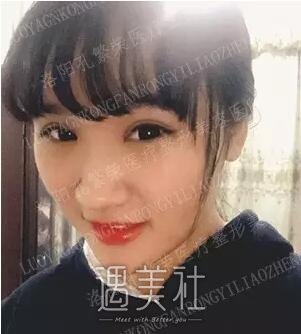 洛阳孔繁荣做双眼皮怎么样?真能出神入化的果?