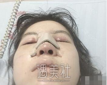 长治市天成美容医院隆鼻案例分享，拥有漂亮的鼻子是如此重要!