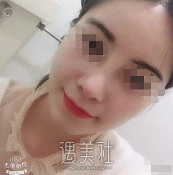 长治市天成美容医院隆鼻案例分享，拥有漂亮的鼻子是如此重要!