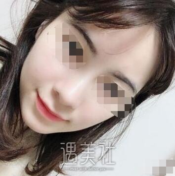 长治市天成美容医院隆鼻案例分享，拥有漂亮的鼻子是如此重要!