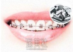 西安成年牙齿矫正多少钱，听说价格很贵哦? width=