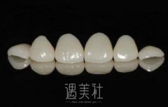 牙齿拥挤能做烤瓷牙吗，做烤瓷牙需要多少钱呢? width=